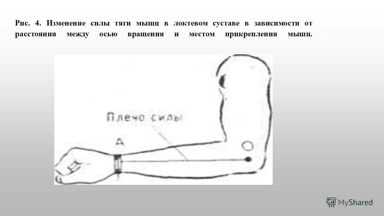 Посттравматический артроз локтевого сустава рентген. Медиальный надмыщелок локтевого. Изменения в локтевом суставе. Остеоартроз локтевого сустава. Ревматоидный артрит коленного сустава рентген картина.