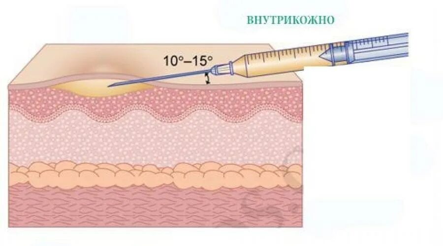 Внутрикожная инъекция. Укол подкожно. Внутрикожный и подкожный. Инъекции внутрикожно подкожно.
