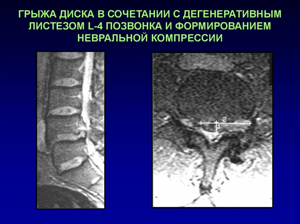 Аномалии развития позвоночника. Аномалии развития поясничного отдела позвоночника. Аномалия развития тела позвонка. Врожденная аномалия развития позвоночника.