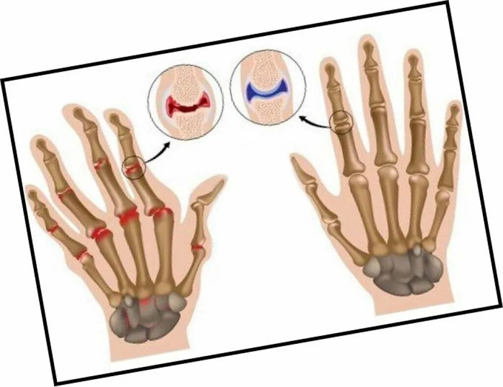 Почему болит кость пальца. Полиостеоартроз суставов кистей рук. Артроз в дистальных межфаланговых. Ревматоидный артрит пястно фаланговый.