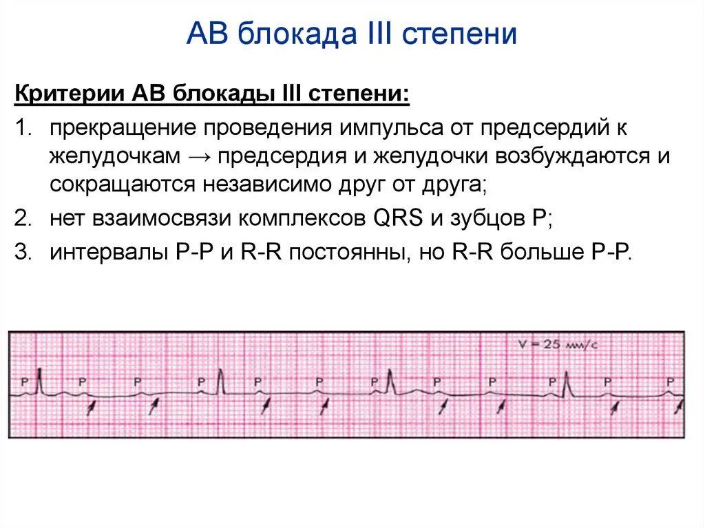 Полная атриовентрикулярная блокада. Признаки av блокады 3 степени на ЭКГ. АВ блокада 3 степени на ЭКГ. ЭКГ критерии АВ блокады 3 степени. Атриовентрикулярная блокада 3 степени на ЭКГ.