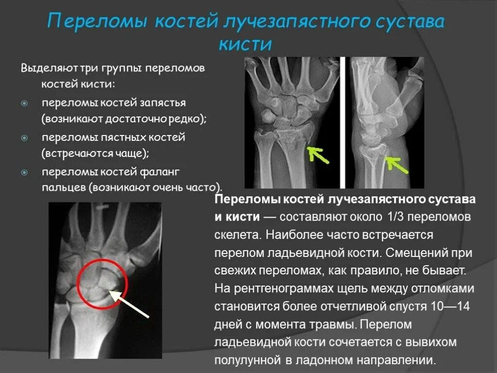 Признаки трещины. Перелом костей кисти ладьевидная кость. Лучезапястная кость перелом симптомы. Внутрисуставные переломы лучезапястного сустава. Рентген правой лучезапястного сустава пeрeлом.