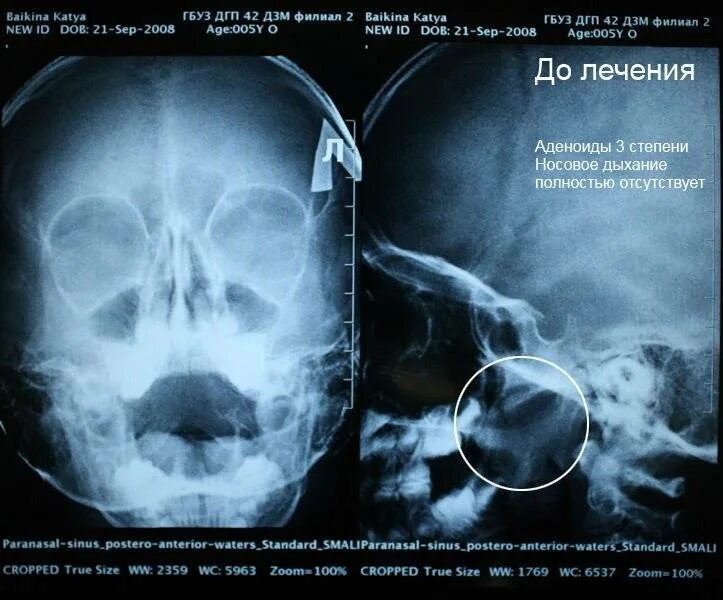 Рентген аденоиды радиография. Аденоиды 2 степени снимок рентген. Аденоиды 2 степени рентген. Аденоидные вегетации 1