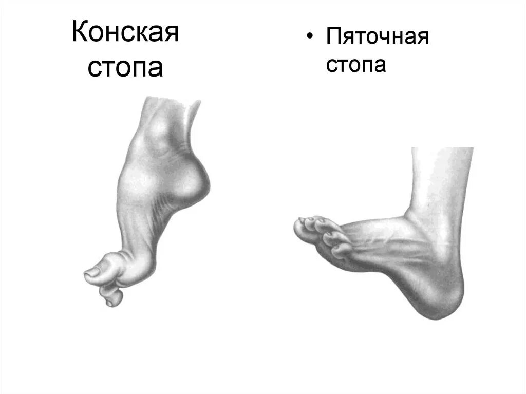 Сустав шарко. Стопа Фридрейха (конская стопа).. Контрактура стоп конская стопа.