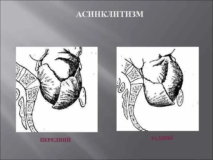 Лимановский асинклитизм. Асинклитизм Редерера. Асинклитическое вставление плода.