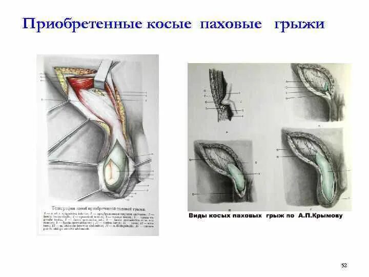 Канатиковая паховая грыжа. Косая паховая грыжа паховая ямка. Паховая грыжа косая косая. Правосторонняя косая паховая грыжа. Прямая и косая паховые грыжи