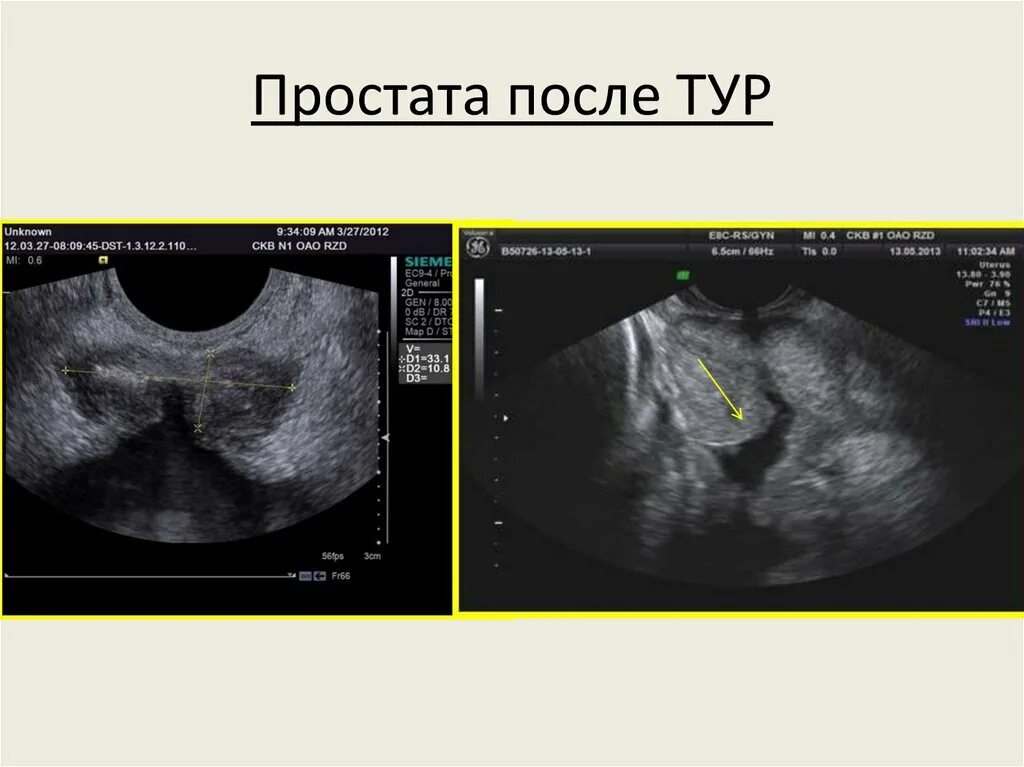 Простата после тур на УЗИ. УЗИ после тур предстательной железы. УЗИ картина предстательной железы.