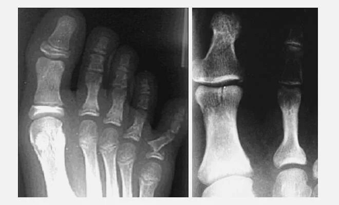 Краевой перелом фаланги рентген. Перелом фаланги пальца стопы рентген. Перелом большого пальца на ноге рентген фаланга. Перелом большого пальца на ноге рентген. Ногтевая фаланга ноги