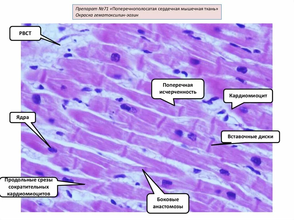 Сердечная мышечная ткань гематоксилин эозин. Поперечно полосатая сердечная мышечная ткань гематоксилин эозин. Воспаление мышечной ткани. Поперечная исчерченность кардиомиоцитов. Препарат поперечно полосатая мышечная ткань