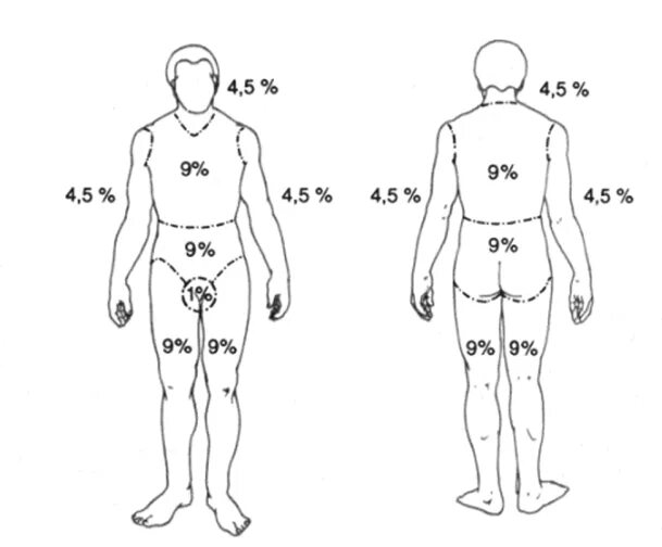 Ожоги проценты поражения. Метод определения площади ожога правило ладони. Площадь ожогов методом девяток. Площадь ожогов правило девяток. Площадь ожога схема.