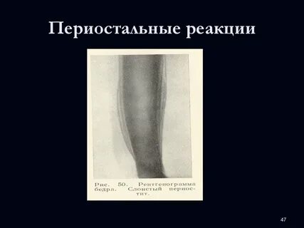 Периостальная реакция