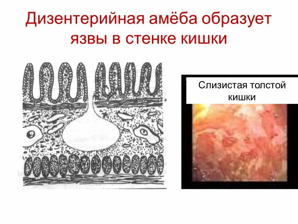 Стадия амебы поражающая толстый кишечник человека. Дизентерийная амёба образует в стенке кишечника. Дизентерийная амеба образуется в стенке кишечника. Дизентерийная амеба в толстой кишке. Дизентерия амеба образует.