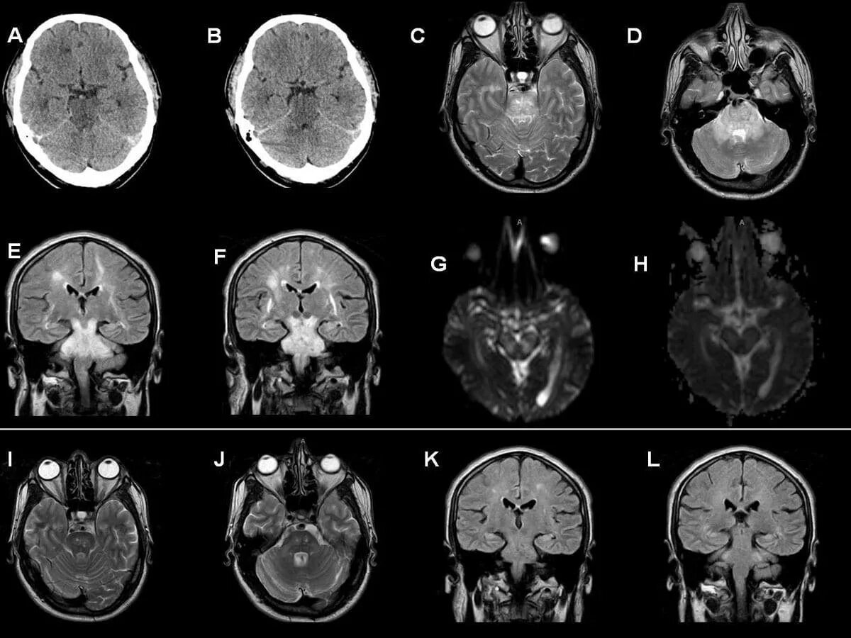 Кт томограмма головного мозга. Компьютерная томография кт головного мозга. СКТ головного мозга снимок. Рентгеновская компьютерная томография головного мозга.