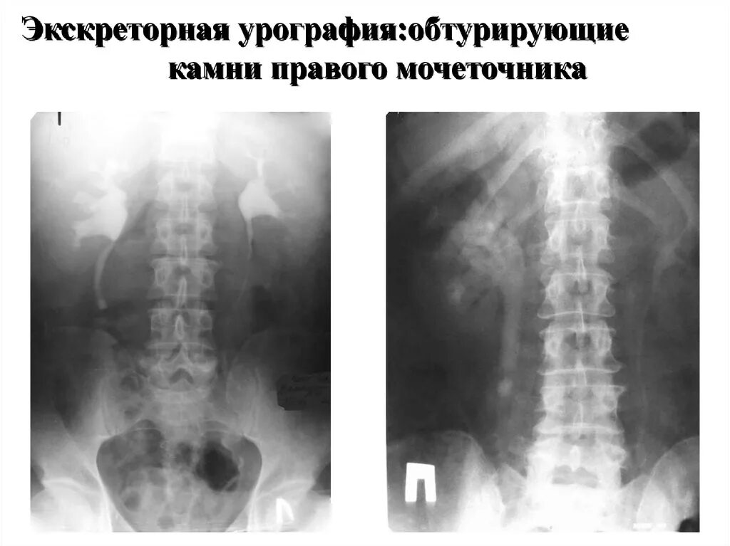 Рентген мочеточника. Экскреторная урография конкременты мочеточник. Урография камень в мочеточнике. Экскреторная урограмма мочекаменная болезнь. Обзорная урография камень мочеточника.