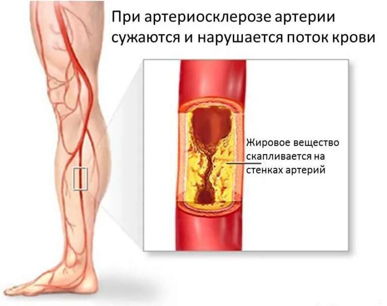 Ишемия нижних конечностей лечение. Облитерирующий атеросклероз клиника. Облитерирующий эндартериит патогенез. Этиология облитерирующего атеросклероза сосудов нижних конечностей. Атеросклероз периферических артерий.