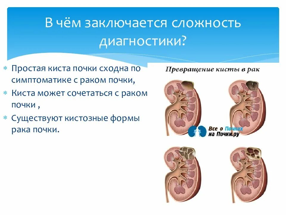 Шоколадная киста почки. Кисты почек классификация.