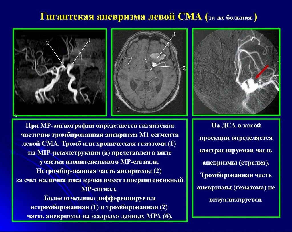 Сегмент а1 пма. Тромбоз средней мозговой артерии мрт. Сосудистые мальформации кт мрт. Аневризма артерии головного мозга кт. Аневризма средней мозговой артерии мрт.