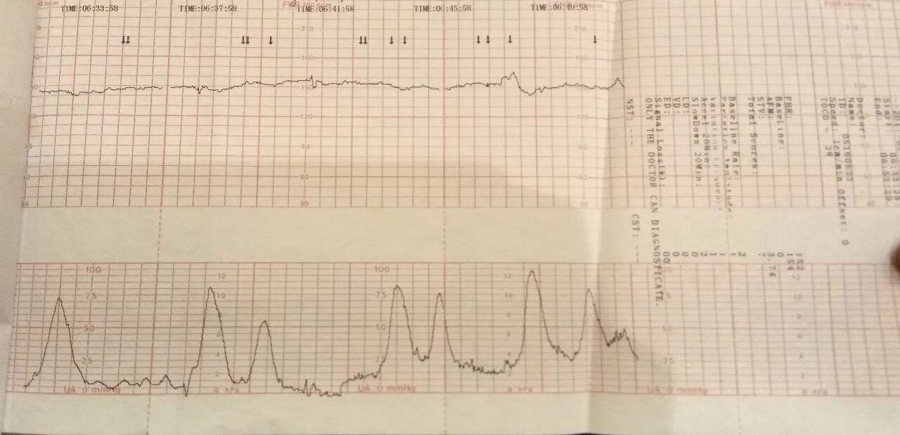 КТГ при сильных схватках. КТГ плода схватки на КТГ. Родовые схватки на УТГ. КТГ при схватках показатели. Схватки на 30 неделе