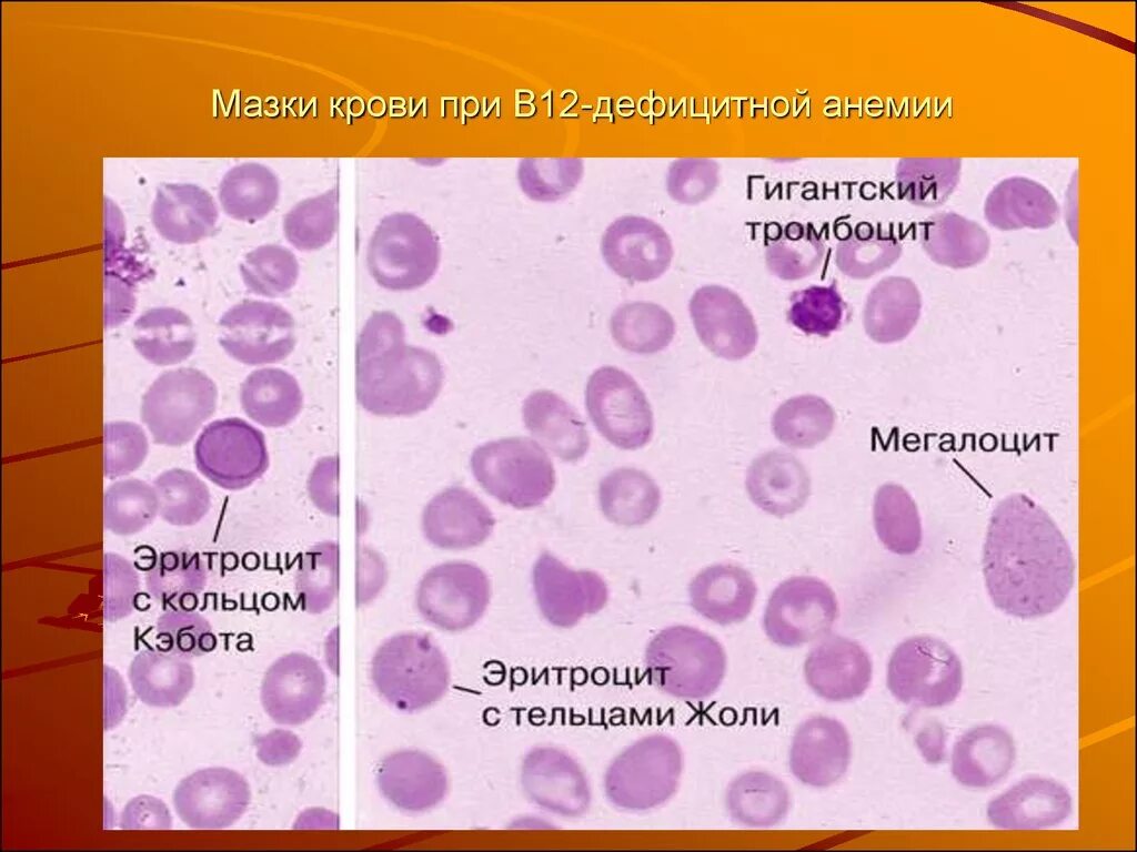 Синдром тельца. В12 дефицитная анемия мазок крови. Мегалобластная анемия мазок крови. В12 дефицитная анемия периферическая кровь. Эритроциты при в12 дефицитной.