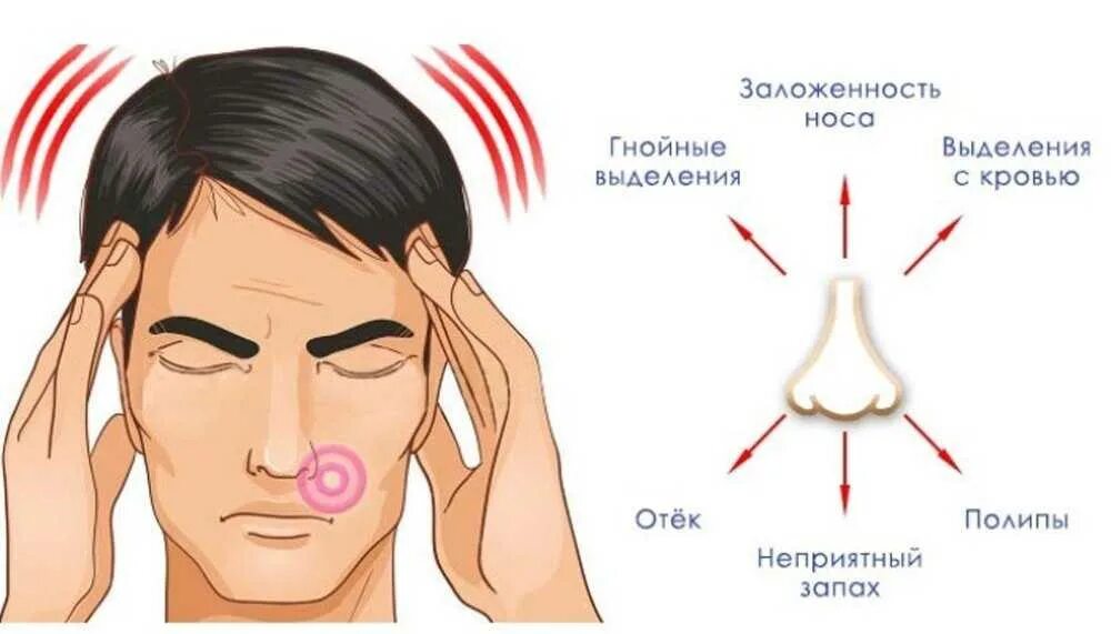 Постоянно заложен нос причины. Острый синусит симптомы. Симптомы при синусите гайморите.