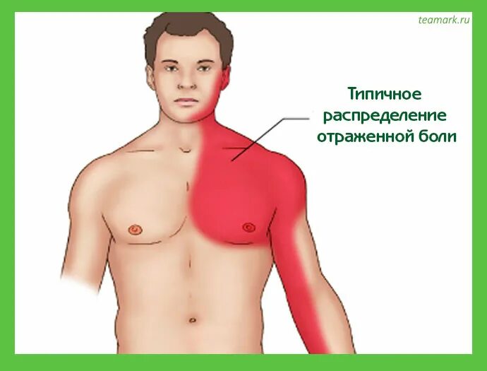 Иррадиация стенокардии. Инфаркт миокарда локализация боли. Локализация боли при инфаркте миокарда. Стенокардия локализация боли. Боль за грудиной при инфаркте.