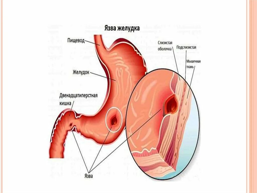 Язва желудка и 12 перстной кишки. Язвенная болезнь желудка язвенная болезнь 12 перстной кишки. Язва двенадцатиперстной кишки анатомия.