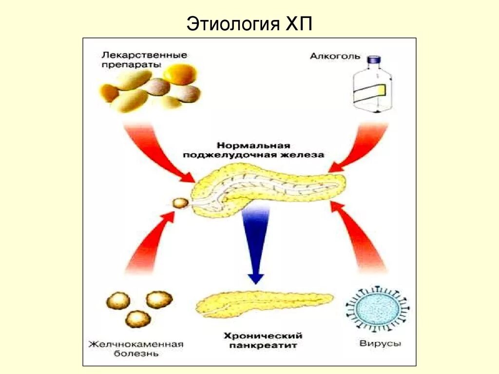 Этиопатогенез хронического панкреатита. Схема патогенеза панкреатита. Хронический панкреатит этиология. Патогенез панкреатита патофизиология. Вторичный панкреатит