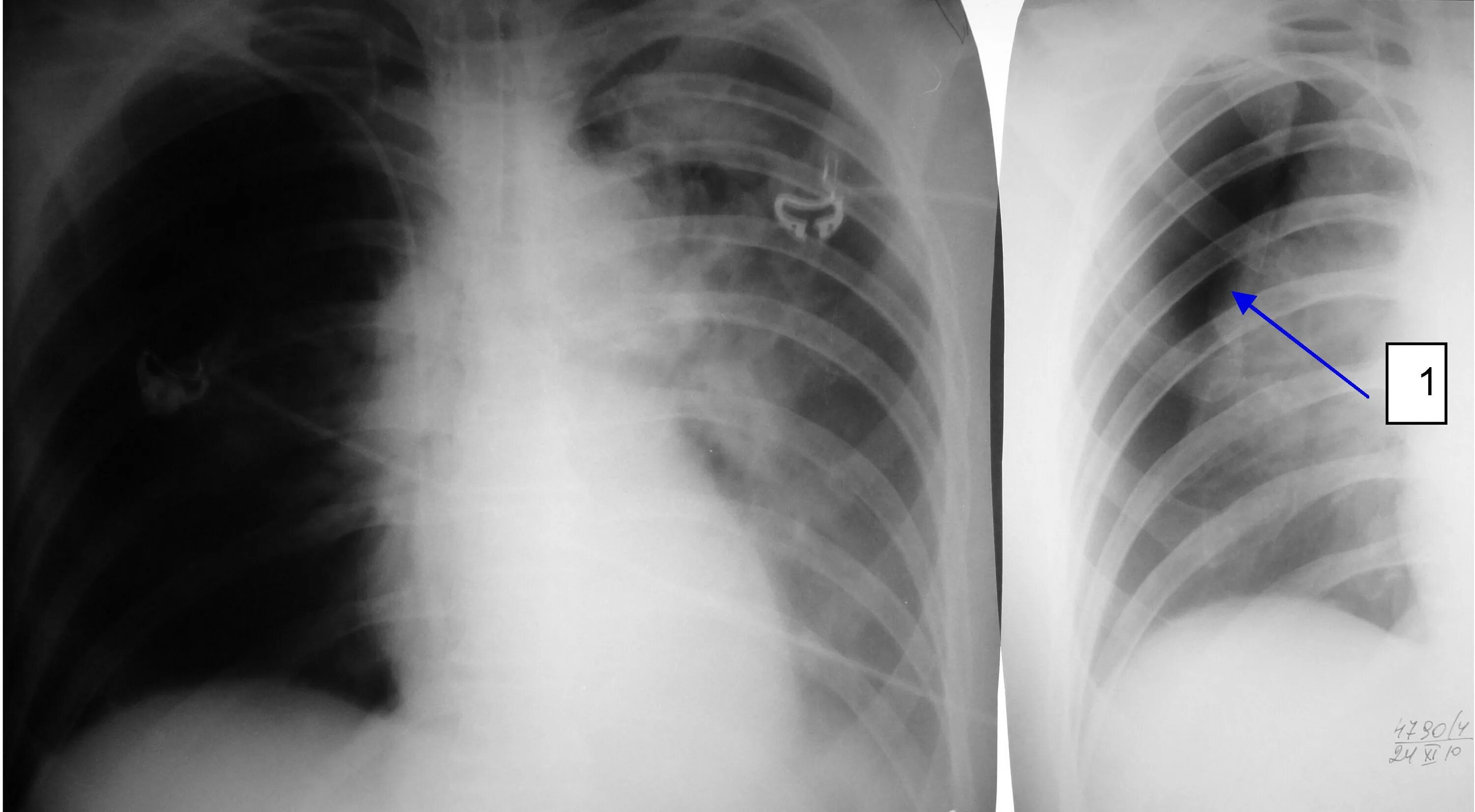 Операция по удалению легкого. Пневмонэктомия торакоскопия. Сегментарная резекция легкого. Лобэктомия и пневмонэктомия. Пневмоторакс левого легкого рентгенограмма.