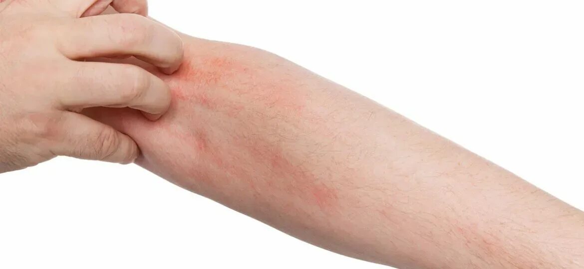 Лабораторная штриховое раздражение кожи. Фотоаллергический дерматит. Аллергические покраснения на руках.