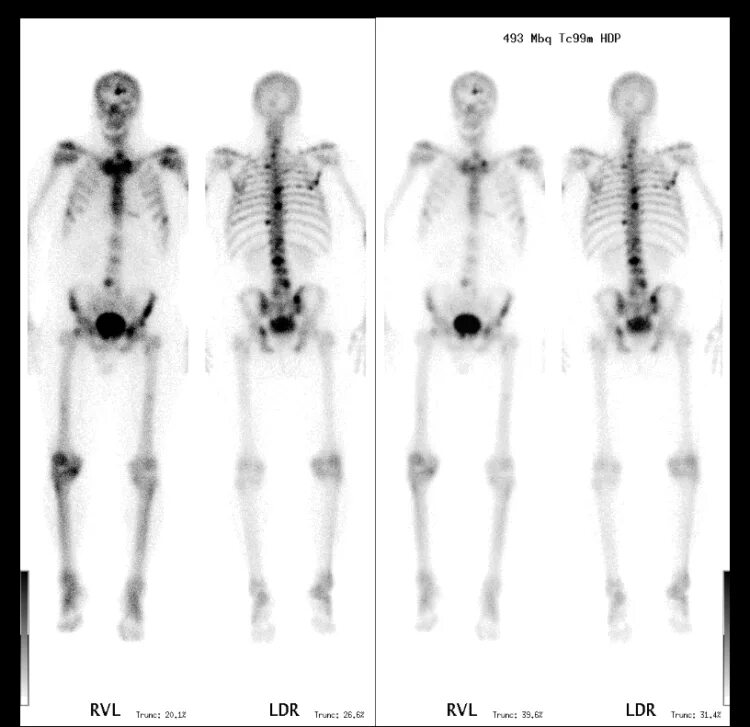 Сцинтиграфия костей метастазы. Костные метастазы при онкологии. Метастатическое поражение костей скелета. Метастазы в костях снимок.