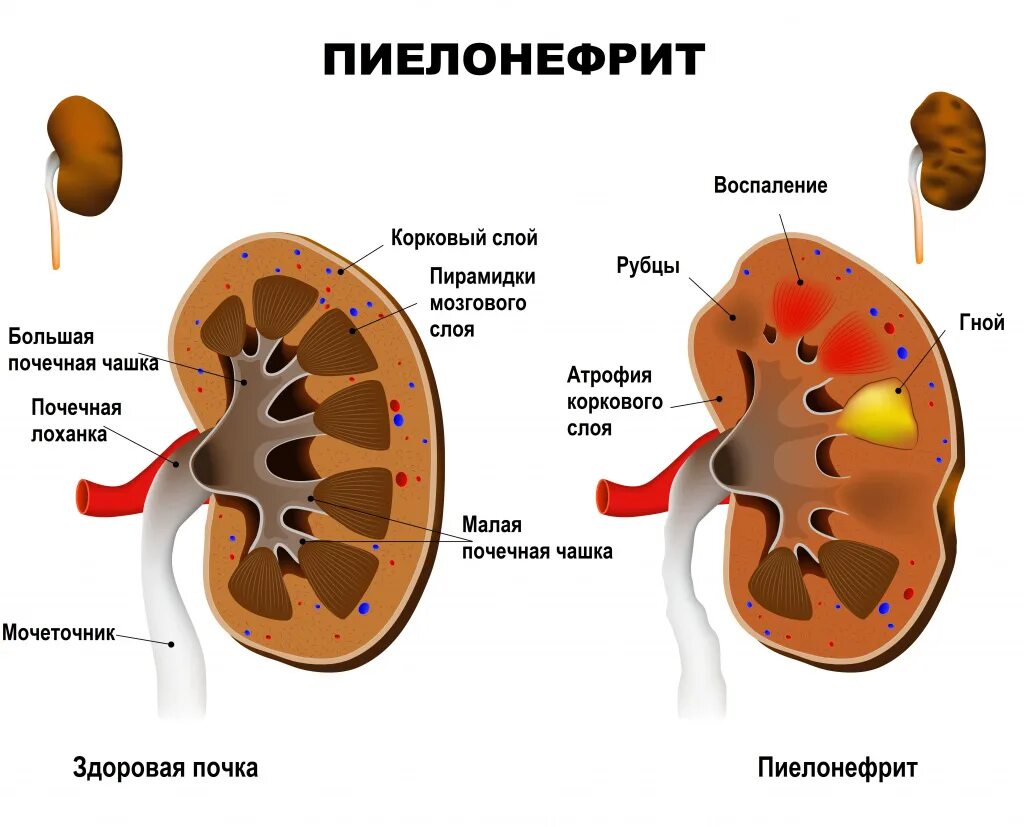 Болезнь почекпилонефрит. Болезнь почек пиелонефрит. Строение чашечно лоханочной системы почек. Патология почки. Пиелонефрит. Пиелит это