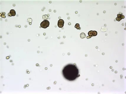 Как выглядят камни в моче