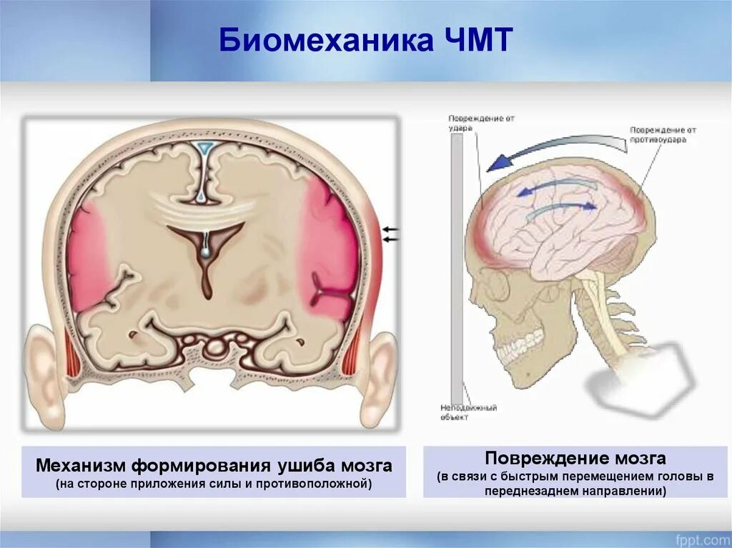 Травма мозга очаговая. Ушиб головного мозга механизм возникновения. ЧМТ ушиб головного мозга. Механизмы повреждения мозга. Закрытая травма головы.