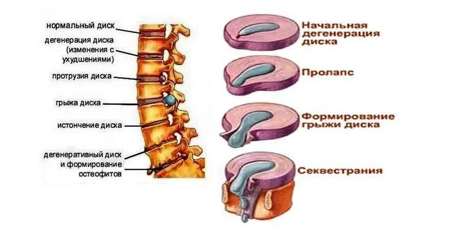 Картина начальных дистрофических изменений