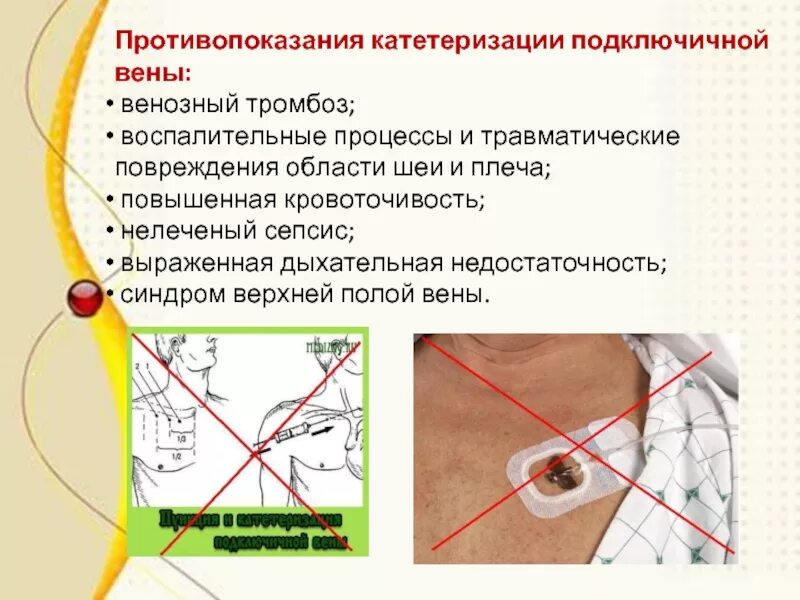 Постановка подключичного катетера алгоритм. Катетеризация подключичной вены. Техника катетеризации подключичной вены. Пункция и катетеризация подключичной вены. Подключичный тромбоз