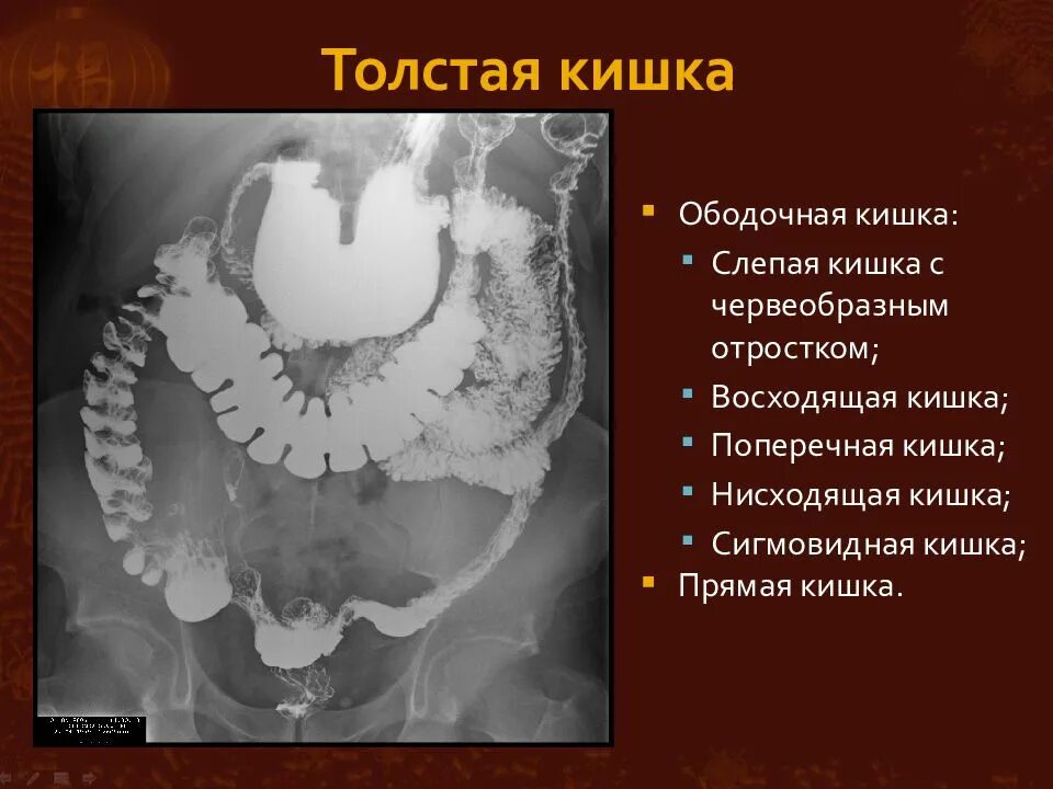 Сигмовидная кишка где находится и симптомы. Восходящая ободочная кишка толстой кишки. сигмообразная ободочная кишка. нисходящая и сигмовидная ободочная кишка. восходящая ободочная кишка кт.
