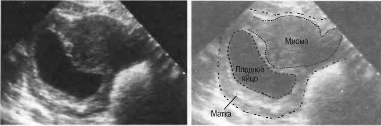 6 мм плодное. Субмукозная миома матки УЗИ. Миома матки при беременности фото УЗИ.