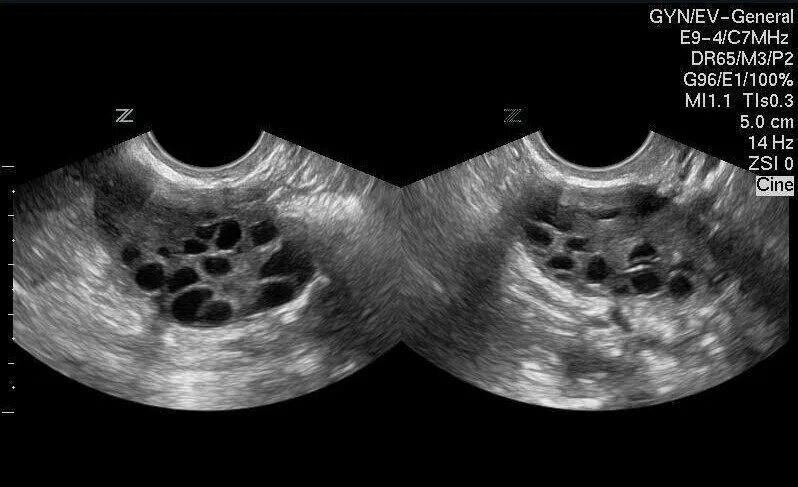 Поликистозные яичники лечение. Синдром поликистоза яичников на УЗИ. Мультикистозные яичники на УЗИ. Многокамерная киста яичника на УЗИ.
