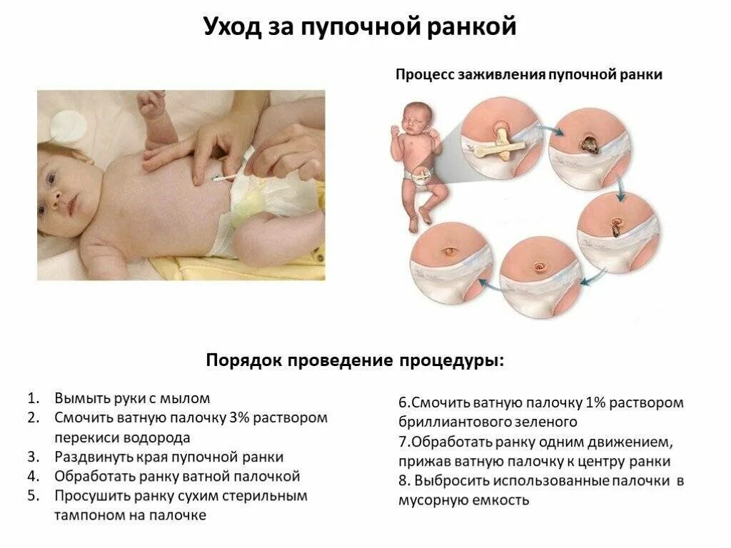Обработка пупочной ранки при омфалите алгоритм. Правила обработки пупочной ранки новорожденного. обработка пупочной ранки новорожденного алгоритм. пупочную ранку новорожденного обрабатывают. обработка пупочной раны алгоритм.