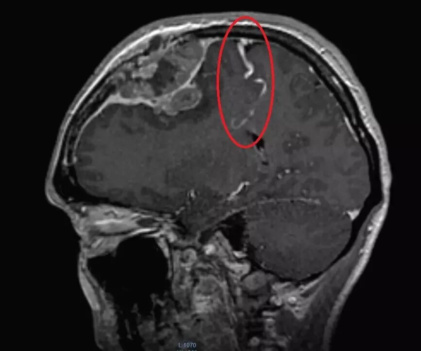 Серпигинозная ангиома. Ангиома головного мозга кт. Гроздьевидная ангиома. Ангиома правой лобной