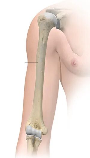 Curved humerus. Masquelet technique humerus.