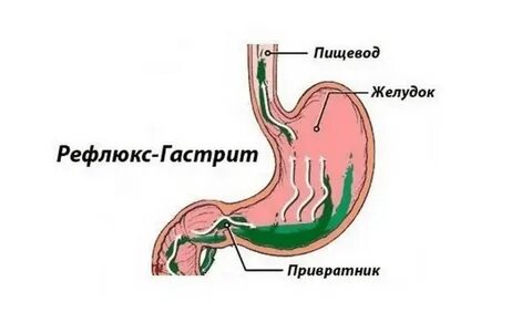 Пузырь в желудке что делать