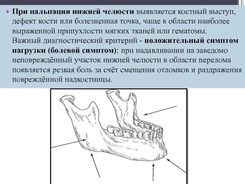 Костный выступ. Двойной перелом нижней челюсти. нижняя челюсть кость. костные выступы в челюсти. костные выступы нижней челюсти.