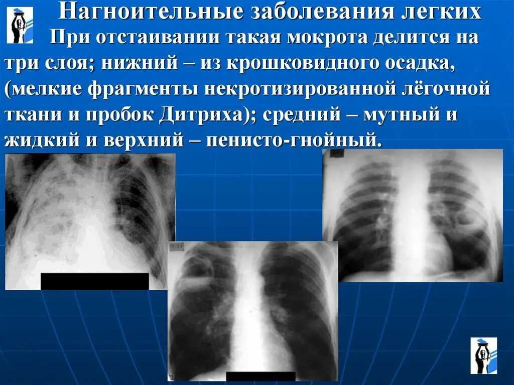 3 поражения легких. Нагноительные заболевания.