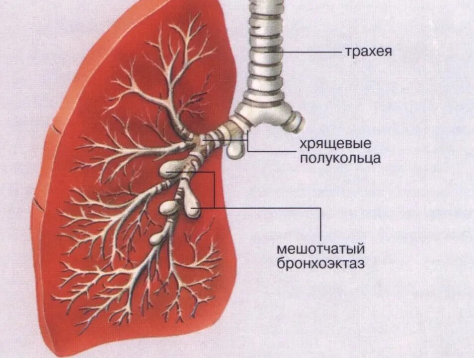 Бронхит бронхоэктатическая болезнь. Бронхоэктазы в легких мешотчатые. Бронхоэктатическая пневмония. Цилиндрические бронхоэктазы легких что это. Бронхоэктатическая болезнь бронхография.