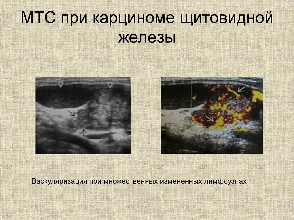 Васкуляризация усилена. Усиление васкуляризации щитовидной железы что это такое. Васкуляризация железы. Что такое умеренная васкуляризация щитовидной железы. Типы васкуляризации щитовидной железы.