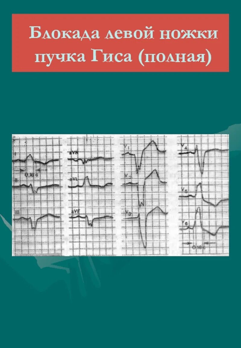 Блок левой ножки пучка Гиса на ЭКГ. Ритм при блокаде левой ножки пучка Гиса. Полная блокада левой ножки пучка Гиса. Блокада левой ножки пучка Гиса на ЭКГ. Левая ножка п гиса