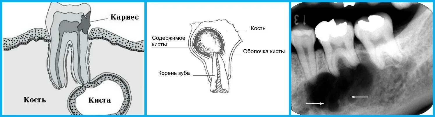 Радикулярная киста стоматология. Радикулярная киста рентгенограмма. Зубы у аиста.