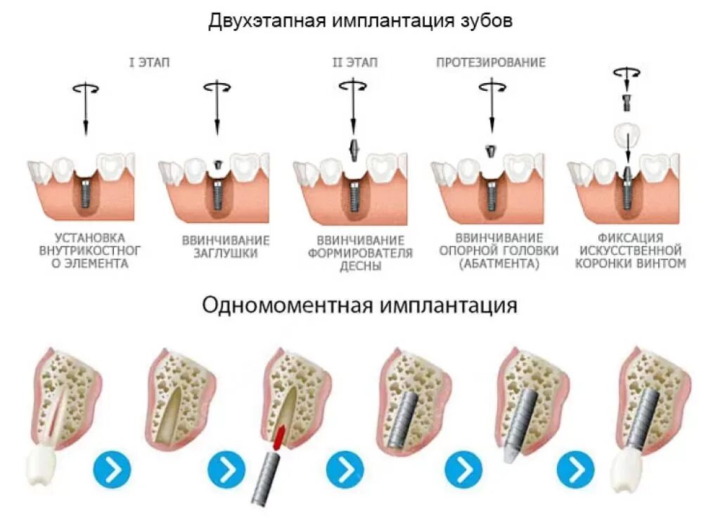 Можно ли поставить зуб после удаления. Одномоментная имплантация зубов этапы. этапы двухэтапной имплантации. схема установки импланта зуба. этапы имплантации зуба абатмент.