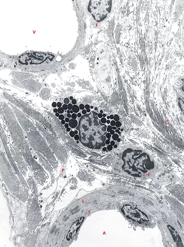 Злокачественная хемодектома гистология. Локализация миофибробластов. Аденома сальных желез гистология. Гематоксилин эрлиха. Гистологический препарат пилорический отдел желудка.